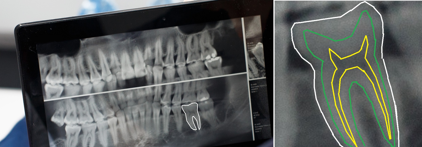 2D tooth model