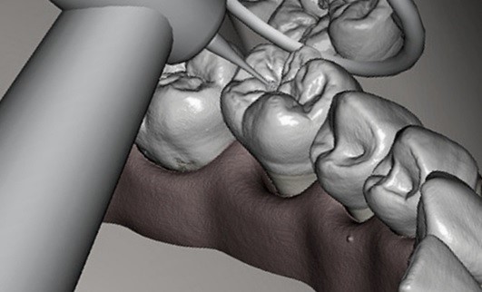A 3D model of teeth generated using AI based on an X-ray image.